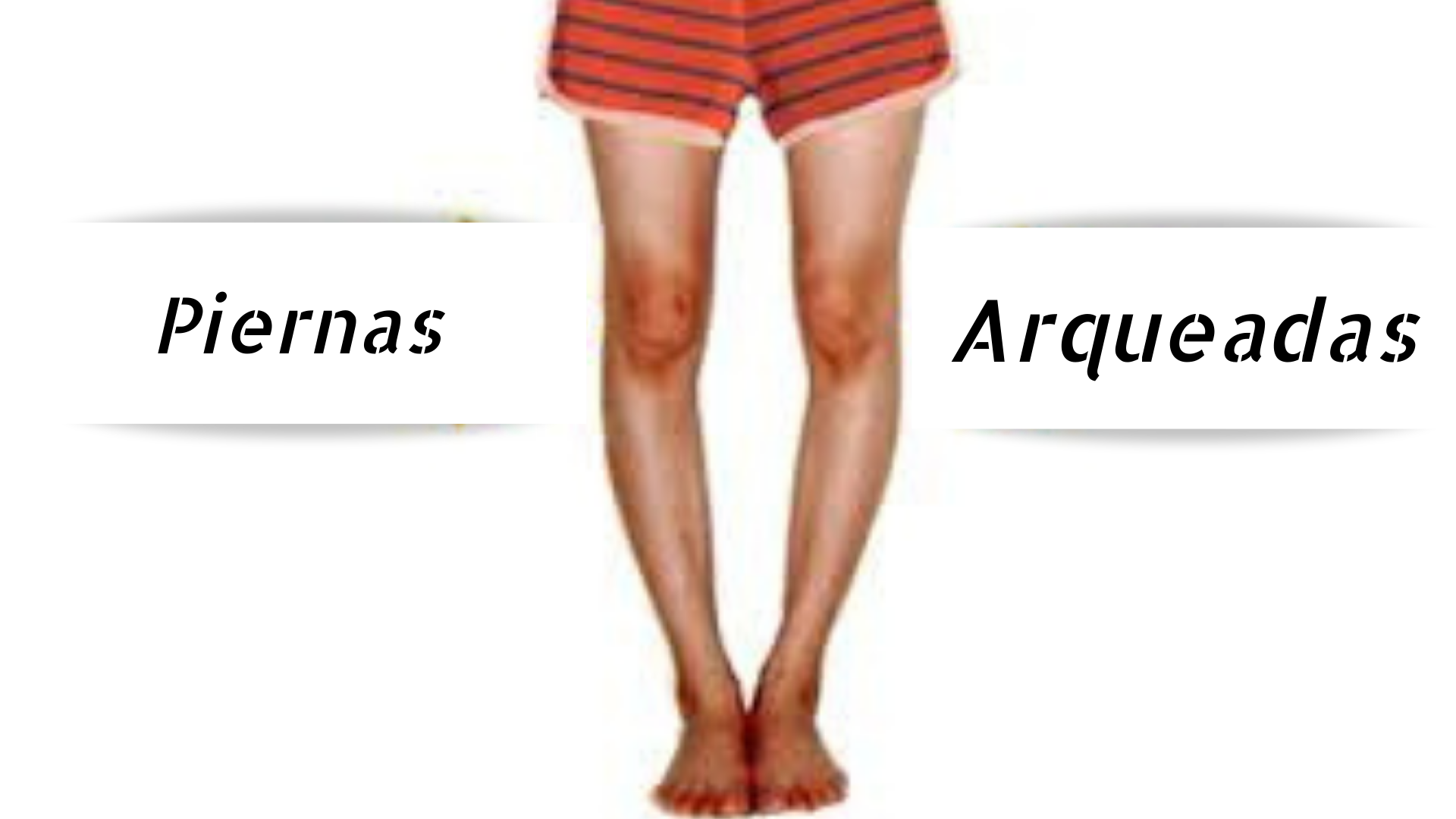 ¿cómo Solucionar El Problema De Las Piernas Arqueadas Y Lucirlas